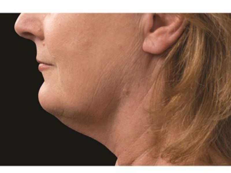 Sagging double chin After CoolSculpting Body Contouring fat loss Treatment in Montreal
