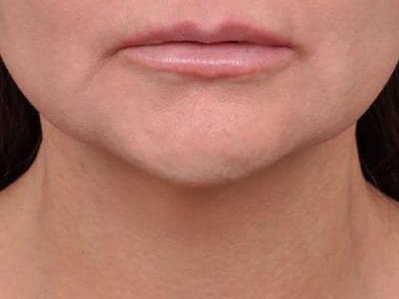 After Profound RF Microneedling treatment for marionette lines - Montreal