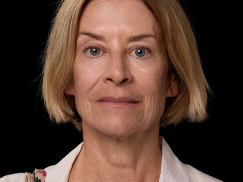 After picture: triLift treatment for mature woman in Montreal at Ideal Body Clinic