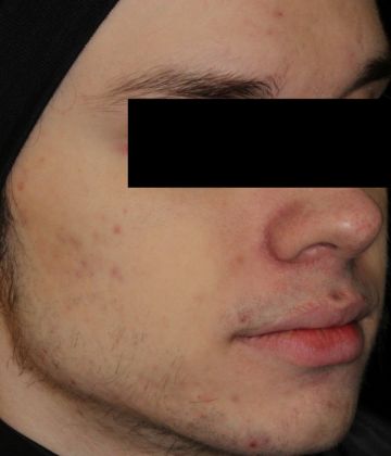 After laser acne removal treatment in Montreal