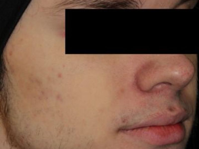 After laser acne removal treatment in Montreal