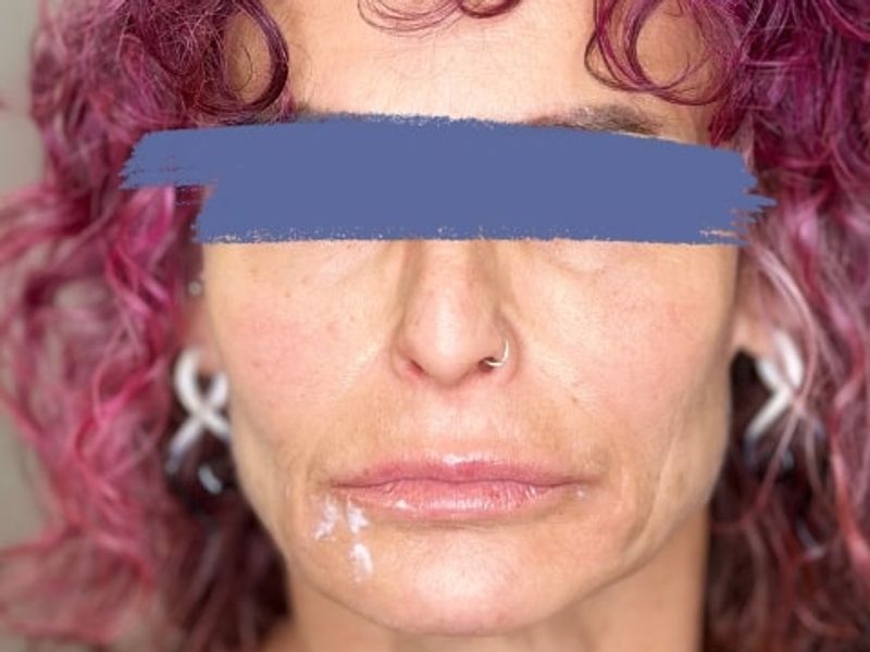 Before Female Lip Fillers procedure at our Montreal aesthetic clinic
