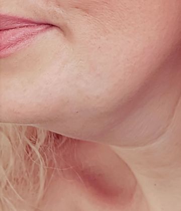 Fat-dissolving injection double chin treatment in Montreal before picture