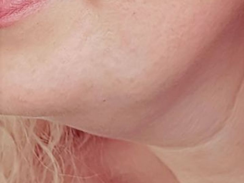 Fat-dissolving injection double chin treatment in Montreal before picture