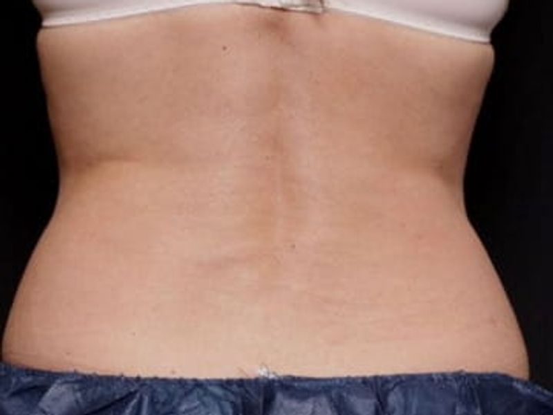 Love handles and back reduction after venus bliss max treatment in Montreal