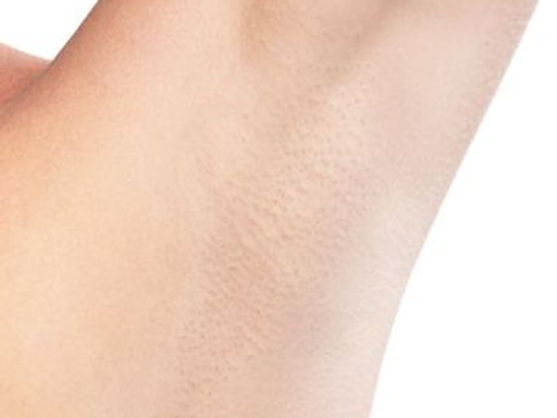 under arms (armpits) laser hair removal after picture treatment in Montreal