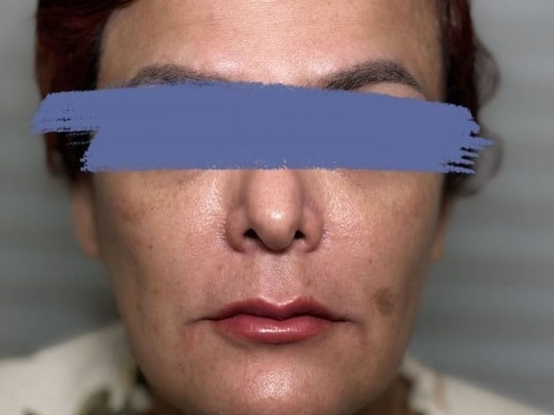 After Male Lip Fillers procedure at our Montreal aesthetic clinic