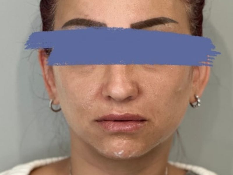 Before Female Lip Fillers procedure at our Montreal aesthetic clinic
