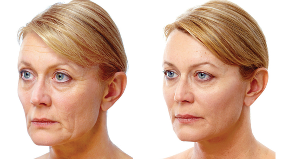 beforeafter