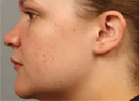 The same cheek after exosomes applied following microneedling, with calmer, smoother skin.