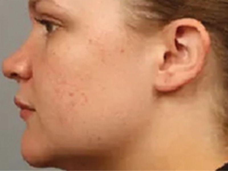 The same cheek after exosomes applied following microneedling, with calmer, smoother skin.