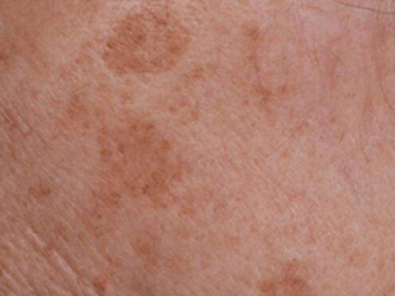 Skin spots removal before Excel HR treatment in Montreal