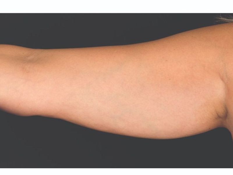 Arm fat Before CoolSculpting Body Contouring fat loss Treatment in Montreal