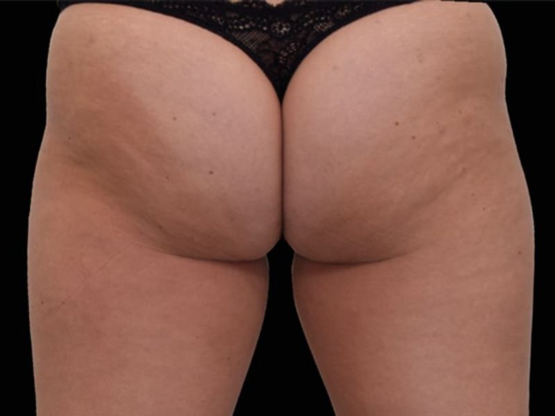 Female Buttocks Before Emsculpt NEO Body Contouring fat removal therapy in Montreal
