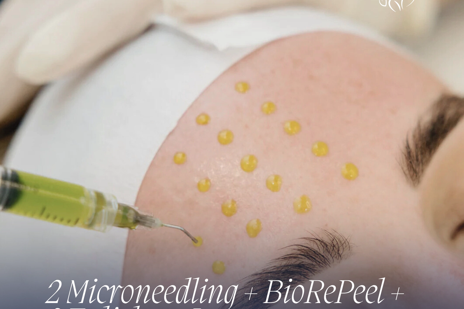 Une Peau Plus Claire et Plus Saine Commence Ici : Découvrez le Protocole Signature Anti-Acné d’Ideal Body Clinic