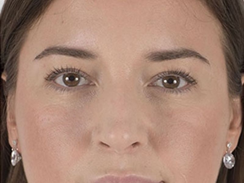 Before Aesthetic Hyaluronic acid lip fillers injectables in Montreal