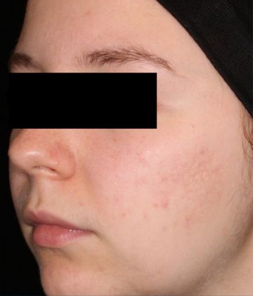 After AviClear laser acne treatment in Montreal