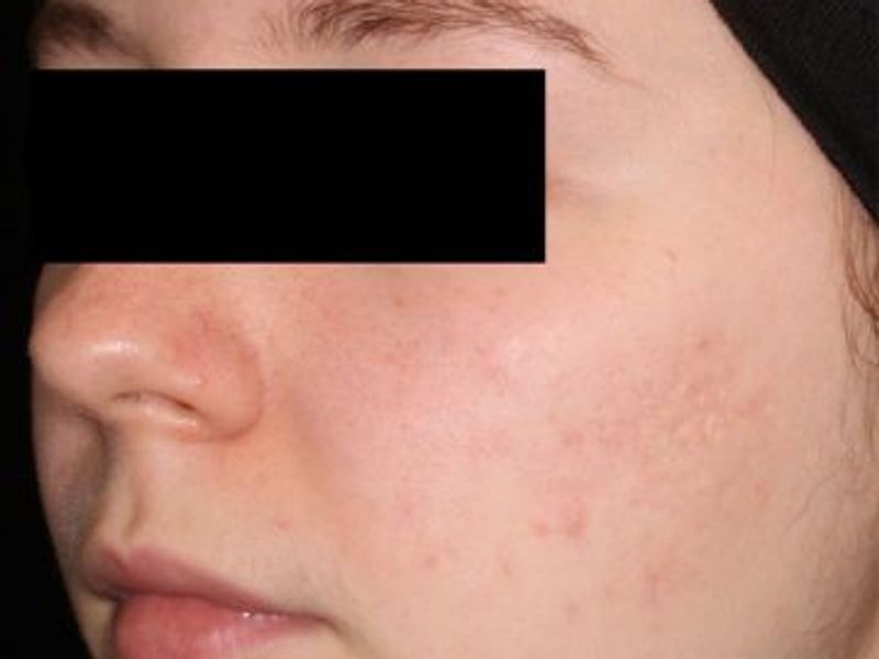 After AviClear laser acne treatment in Montreal
