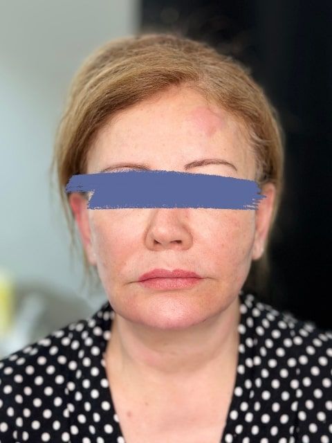 Before Female Collagen-stimulating filler (CaHA) Jawline Fillers procedure at our Montreal aesthetic clinic