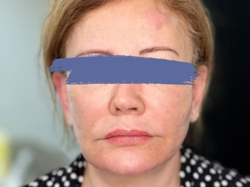 Before Female Collagen-stimulating filler (CaHA) Jawline Fillers procedure at our Montreal aesthetic clinic