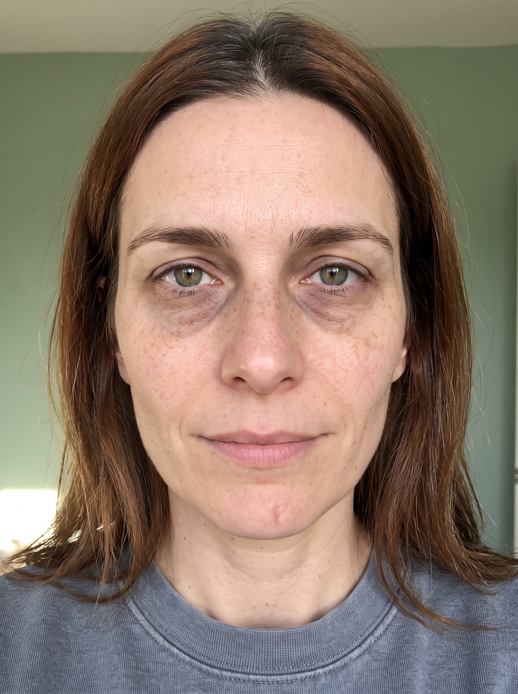 Patient photographed before treatment, facing the camera under even, directional daylight.