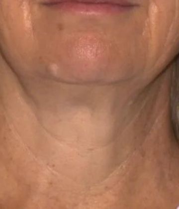 After Sofwave Skin Tightening Treatment in Montreal
