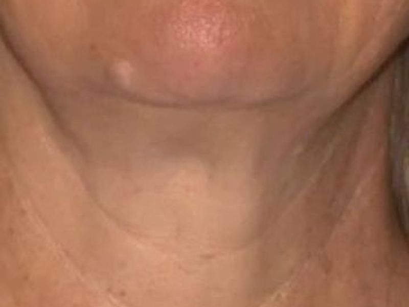 After Sofwave Skin Tightening Treatment in Montreal