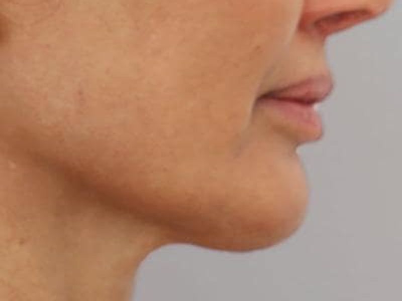 After double chin Profound Radiofrequency Microneedling Skin treatment - Montreal