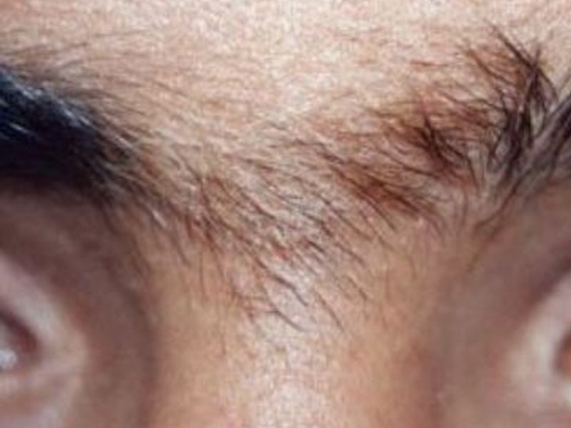 Before Fotona Laser Skin Treatment for facial hair removal - Montreal