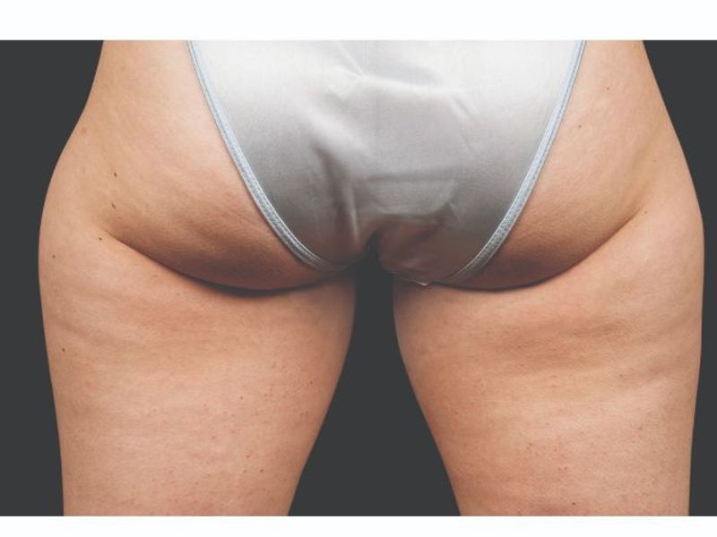 Glutes and thighs Before CoolSculpting Body Contouring fat loss Treatment in Montreal