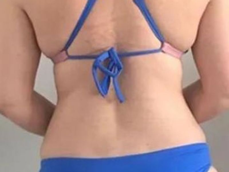 Muffin tops after Slimwave Montreal treatment at Ideal Body Clinic