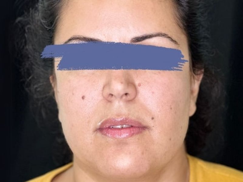Before Female Lip Fillers procedure at our Montreal aesthetic clinic