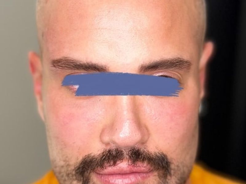 After Male Cat Eyes PDO thread lift procedure at our Montreal aesthetic clinic