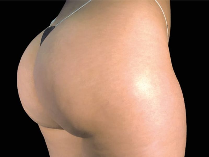 Female glutes After Emsculpt NEO Body Contouring fat removal therapy in Montreal