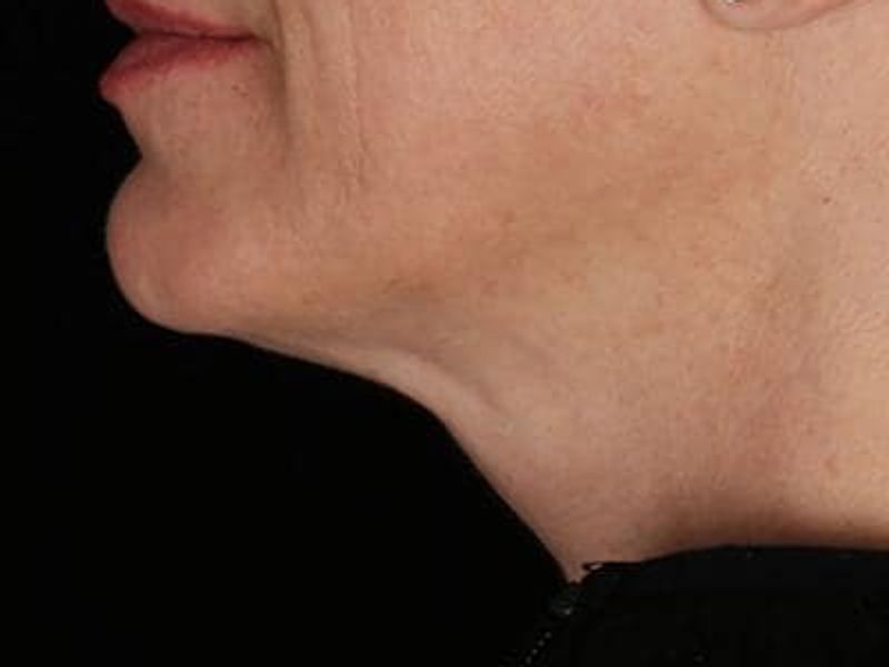 After double chin Profound Radiofrequency Microneedling Skin treatment - Montreal