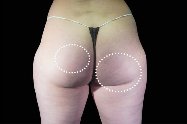Butt cellulite After Emsculpt NEO Body Contouring fat removal therapy in Montreal