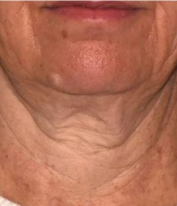 Before Sofwave Skin Tightening Treatment in Montreal