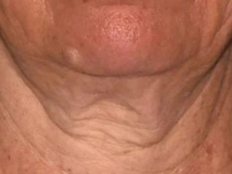 Before Sofwave Skin Tightening Treatment in Montreal