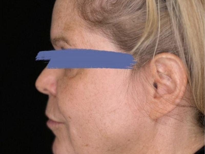 Before Female Jawline PDO thread lift procedure at our Montreal, Quebec aesthetic clinic (side view)