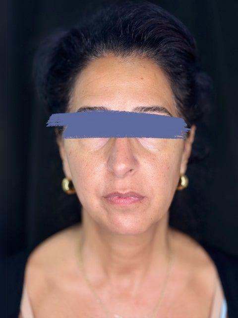 Before Female Cheeks and Marionette Lines Dermal Fillers procedure at our Montreal aesthetic clinic