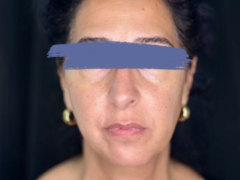 Before Female Cheeks and Marionette Lines Dermal Fillers procedure at our Montreal aesthetic clinic