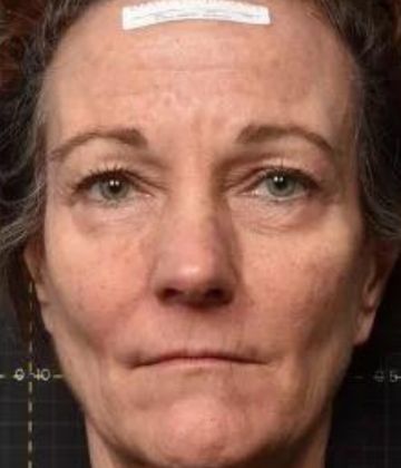 Before Face Sofwave Treatment Picture in Montreal
