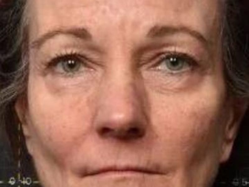 Before Face Sofwave Treatment Picture in Montreal