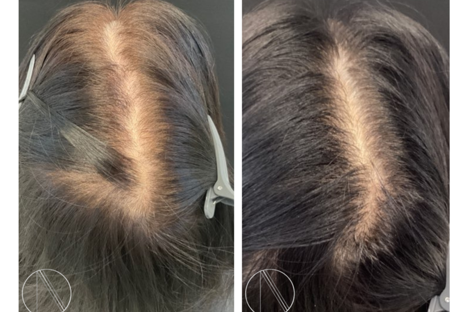 Hair Loss