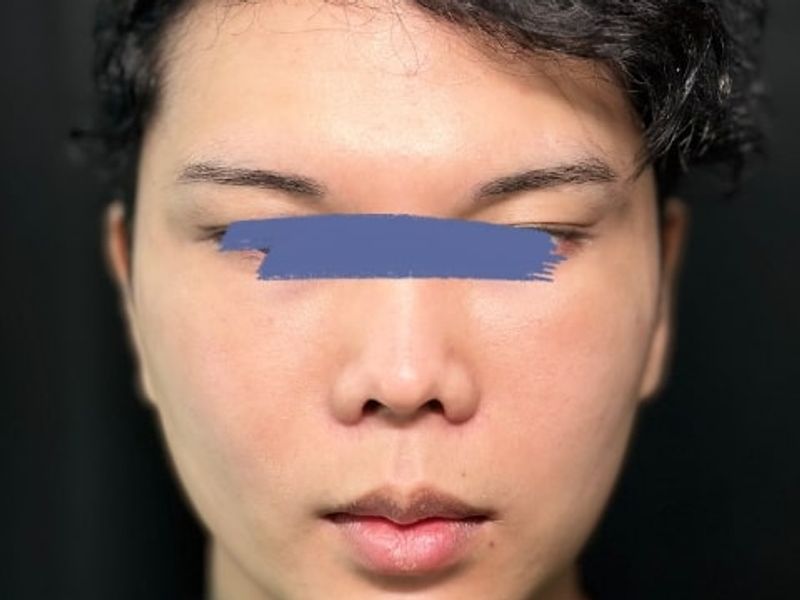 Before Male Cat Eyes PDO thread lift procedure at our Montreal aesthetic clinic