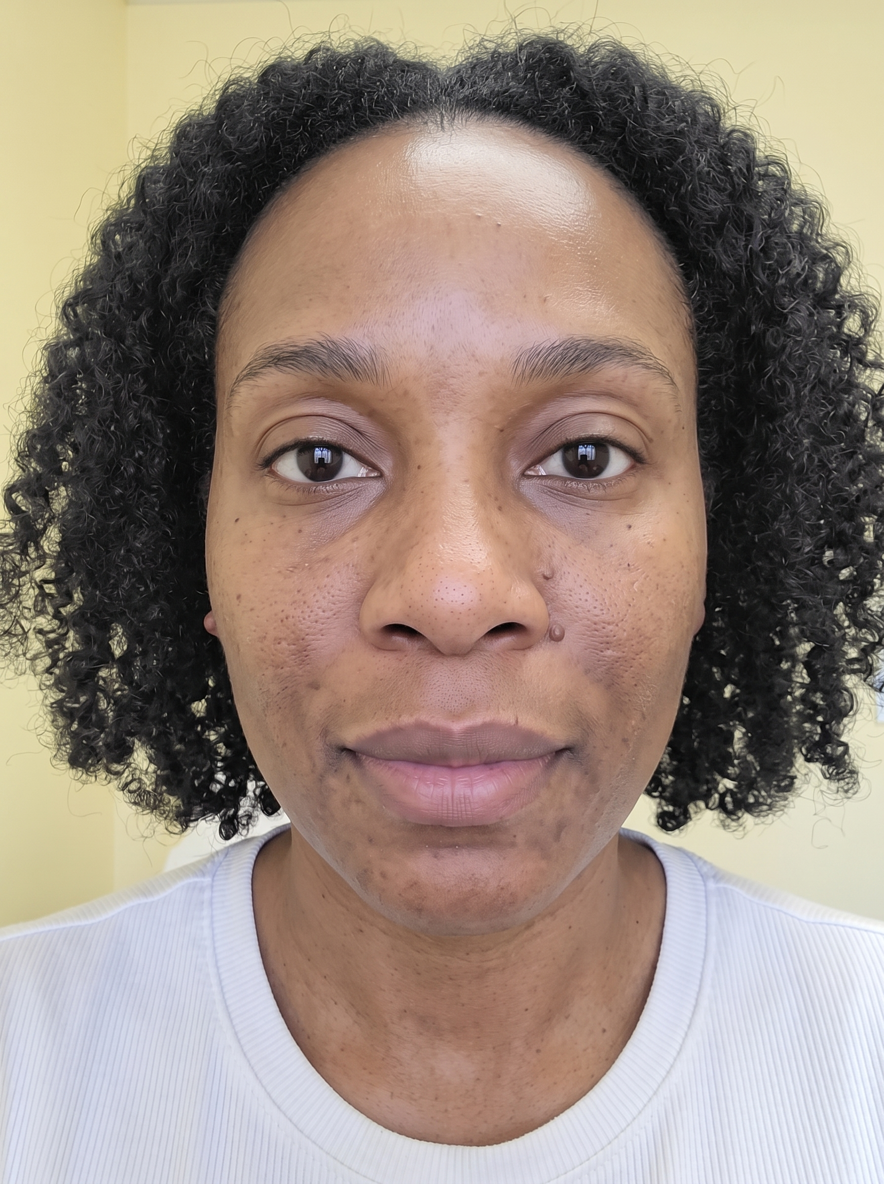 The same patient photographed at a later visit, from the same angle and under the same lighting.