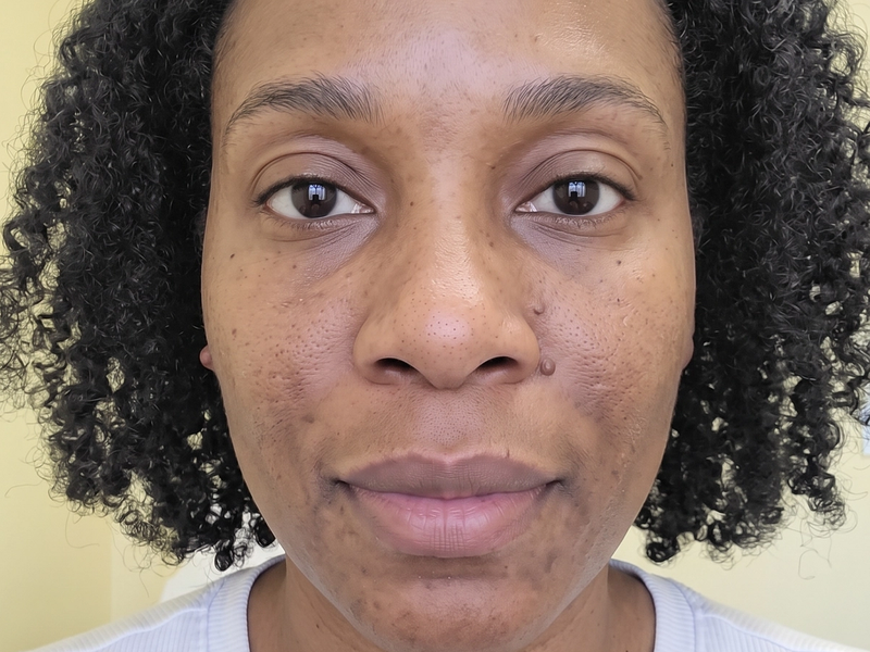 The same patient photographed at a later visit, from the same angle and under the same lighting.
