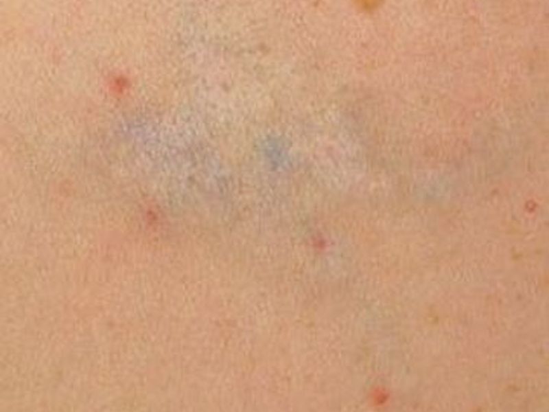 Before Fotona Laser Skin tattoo removal - Montreal