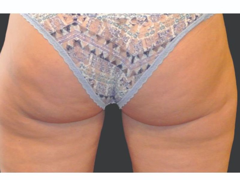Cellulite buttoks and thighs After CoolSculpting Body Contouring fat loss Treatment in Montreal