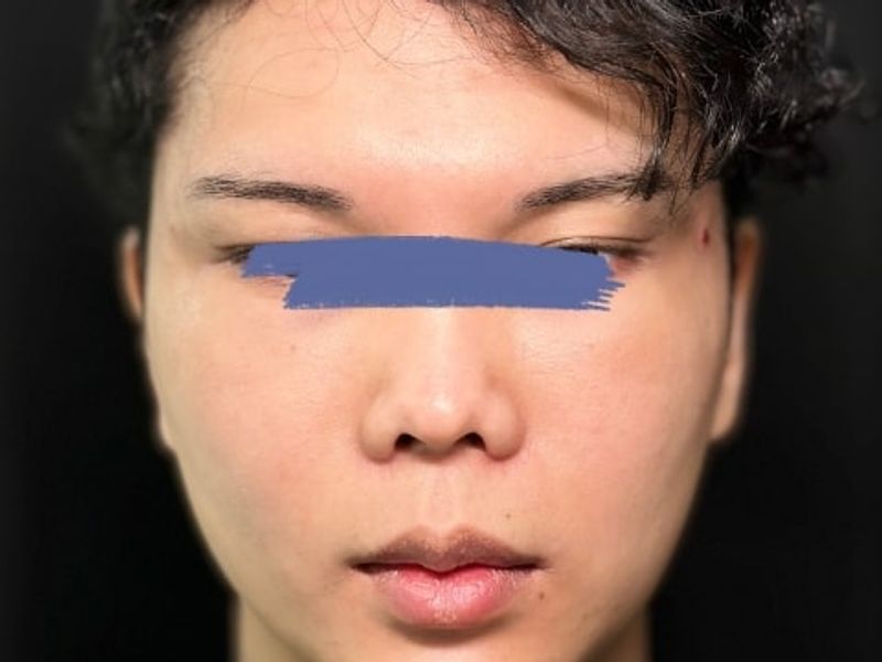 After Male Cat Eyes PDO thread lift procedure at our Montreal aesthetic clinic
